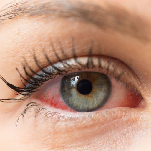 before optilight treatment: redness in eyes